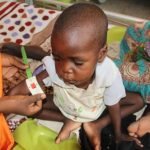 A-child-suffering-from-malnutrition