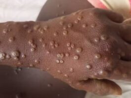 WHO says Mpox still global health threat